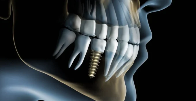 7 Care Tips For Your Dental Implant
