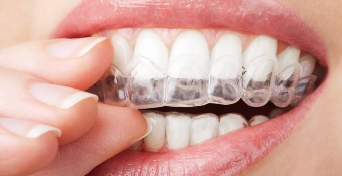 ClearCorrect Vs. Invisalign: Understanding The Differences And Similarities 