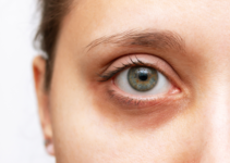 Niacinamide and Dark Circles: What You Need to Know